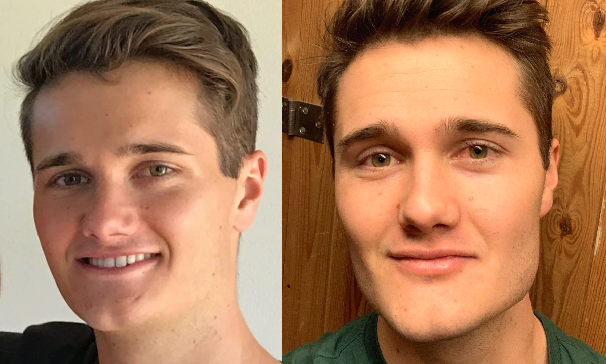 Before and after jawline